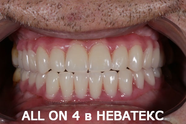 all on 4 фото после операции в клинике Неватекс Москва all on 4 фото после операции